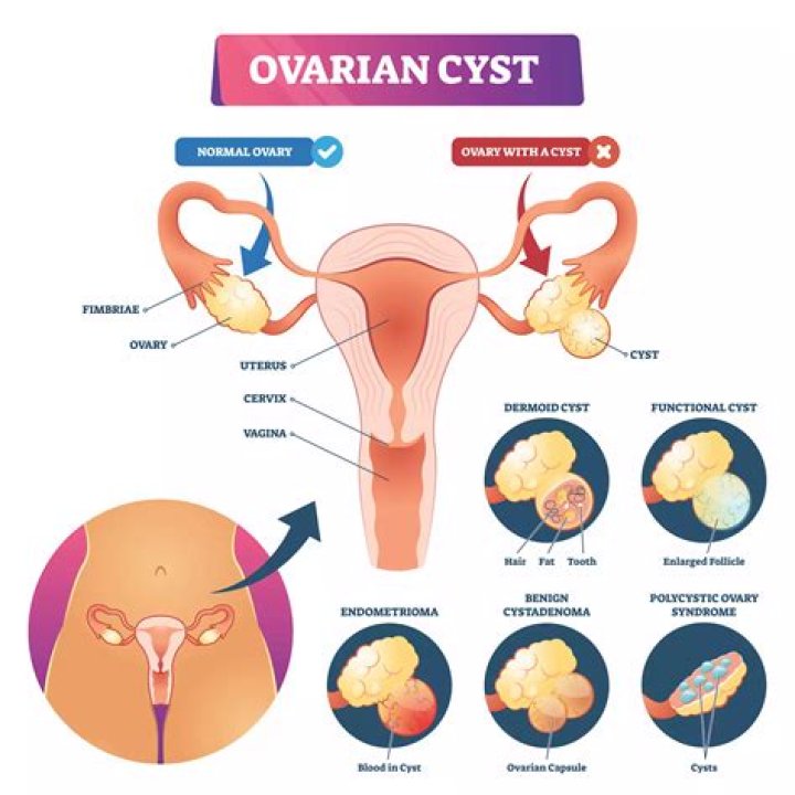 How do you develop ovarian cysts?