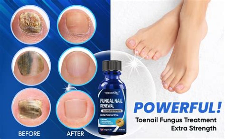 How do you disinfect shoes from toenail fungus?