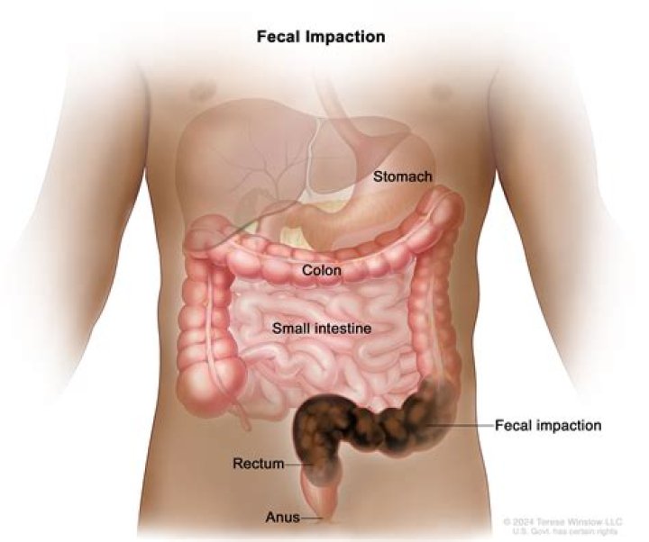 How do you dissolve fecal impaction?