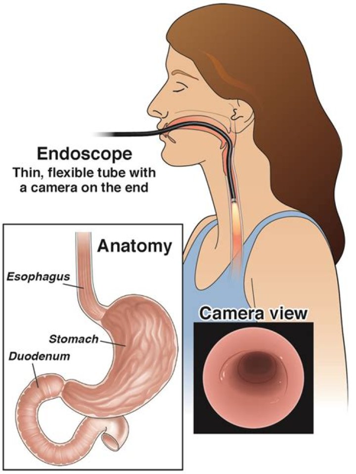 How do you feel after an endoscopy?
