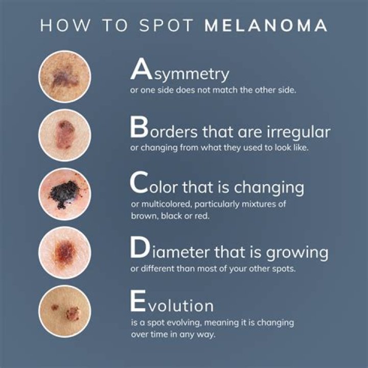How do you feel when you have melanoma?