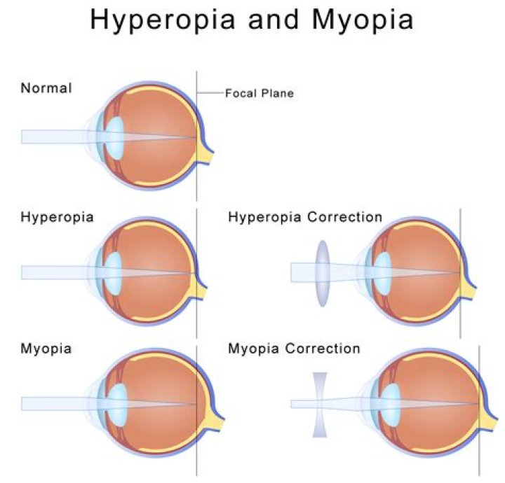 How do you fix presbyopia?