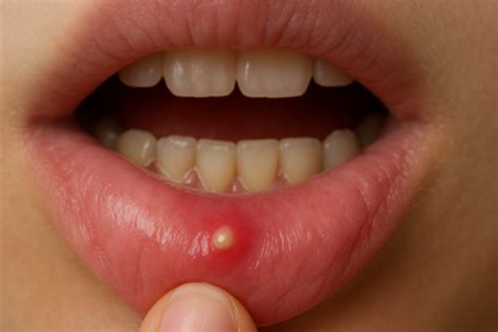 How do you get rid of a pimple inside your mouth?