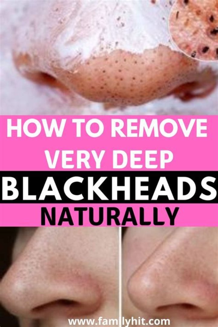 How do you get rid of deep blackheads?