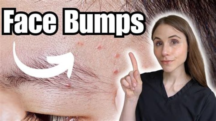 How do you get rid of little bumps on your face without acne?