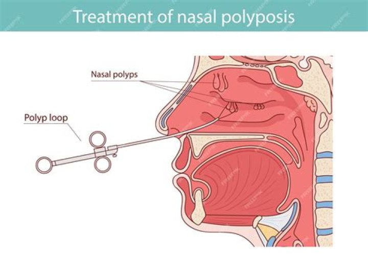 How do you get rid of mouth polyps?