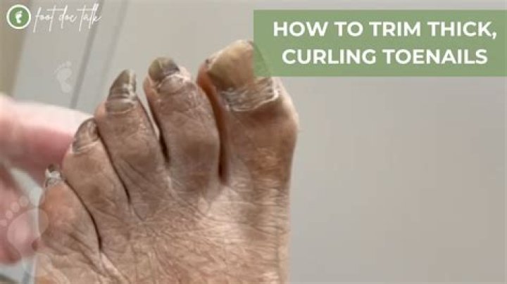 How do you get rid of thick curved toenails?