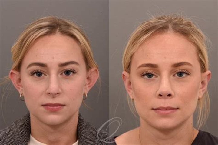 How do you hide otoplasty?