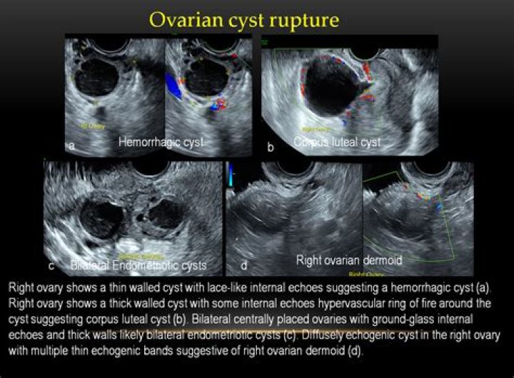 How do you know if an ovarian cyst burst?