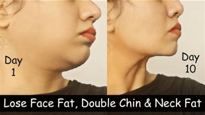 How do you lose chin fat fast?