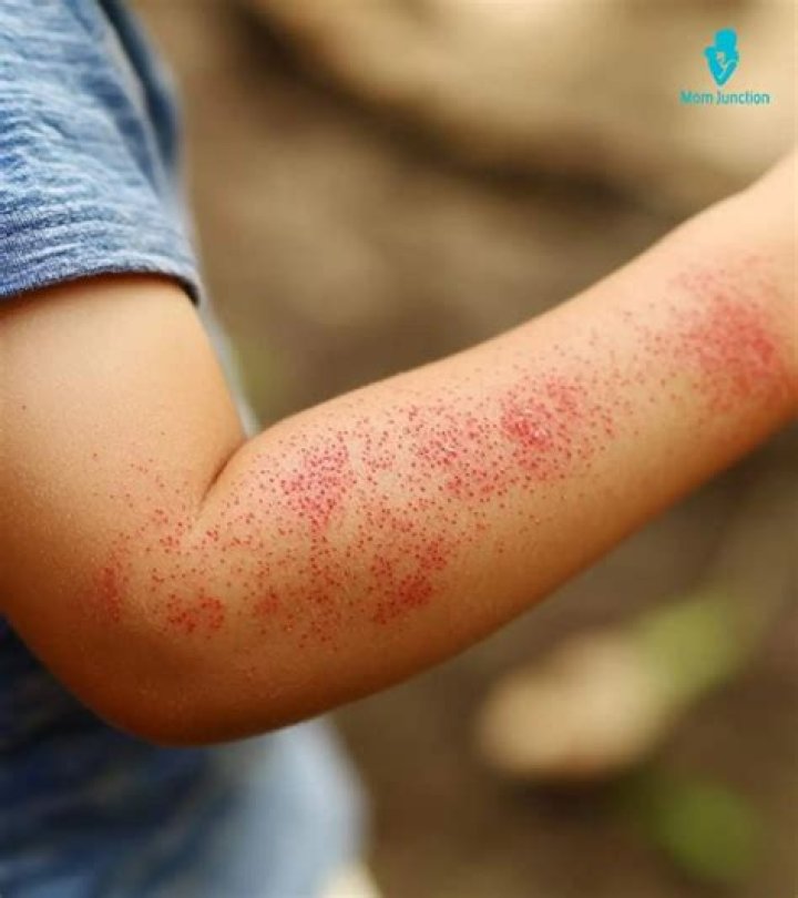 How do you make rashes go away?