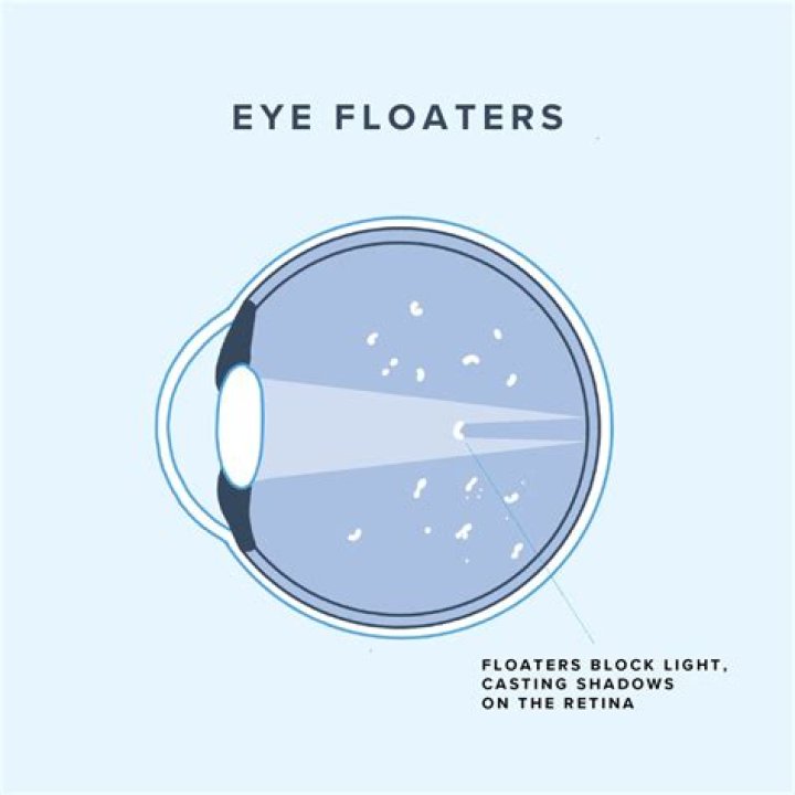 How do you prevent eye floaters?