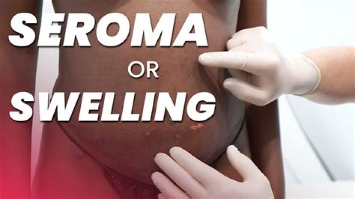 How do you prevent seroma from refilling?