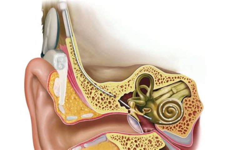 How do you repair cochlea?