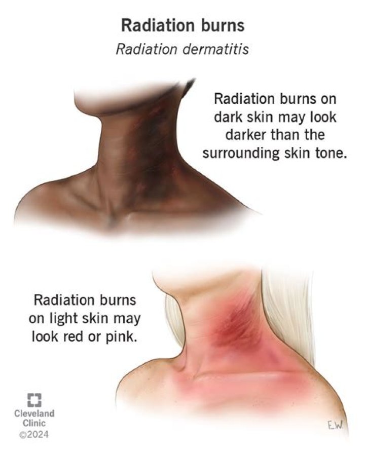 How do you rid your body of radiation?