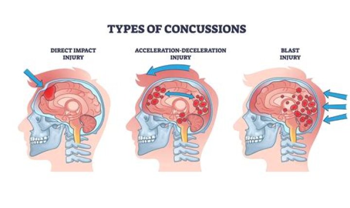 How do you rule out a concussion?