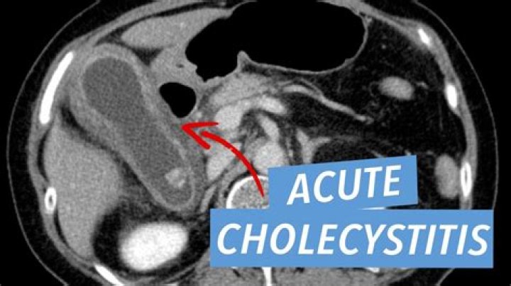How do you rule out cholecystitis?