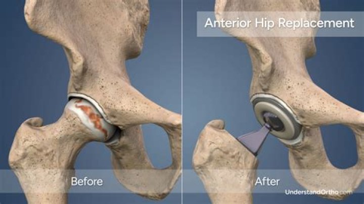 How do you shower after an anterior hip replacement?