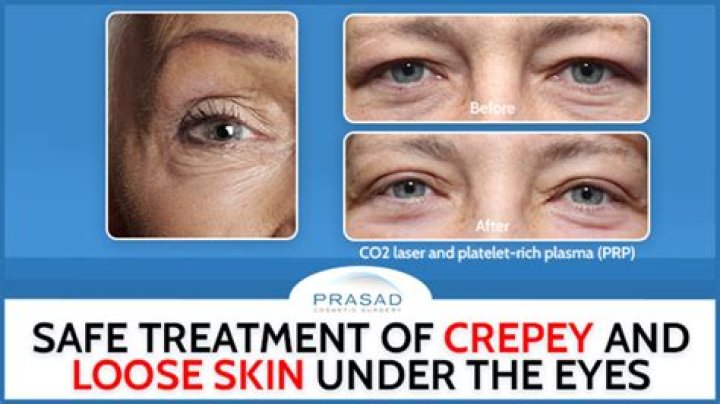 How do you smooth crepey eyelids?