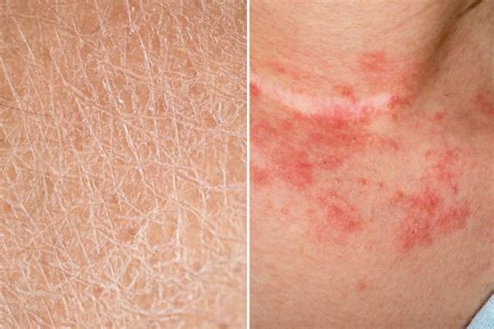 How do you soften hard skin from eczema?