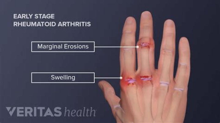 How do you stop arthritis from progressing in fingers?