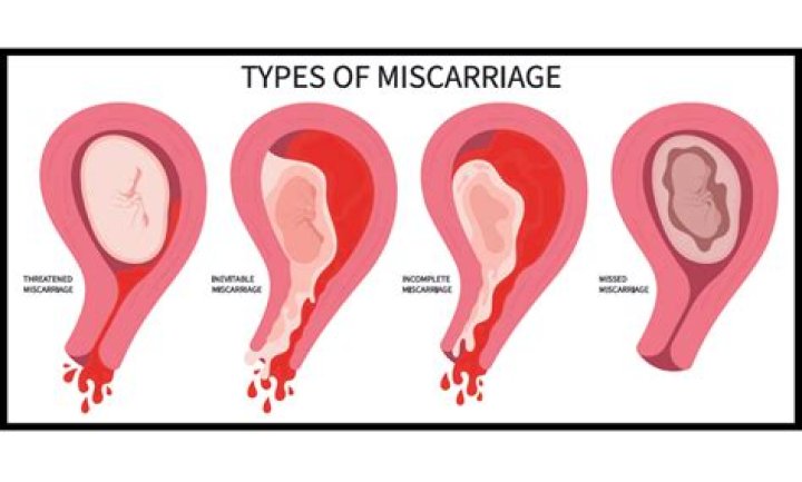 How does a miscarriage feel?