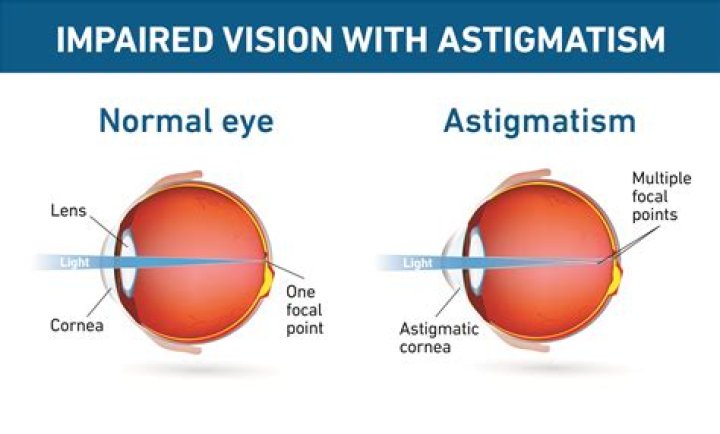 How does an astigmatism look in the eye?