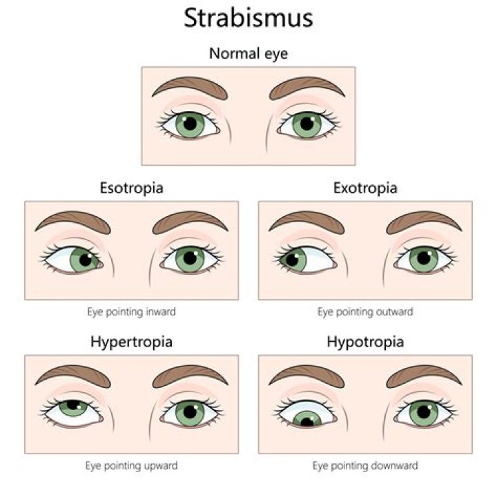 How does strabismus affect a person?