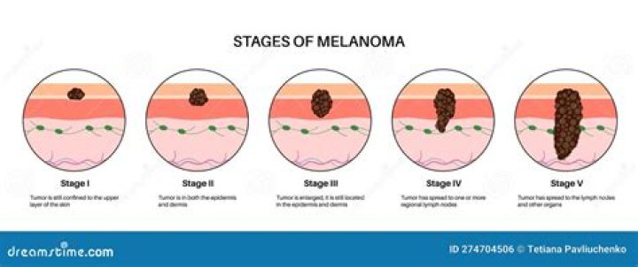 How fast does melanoma grow?