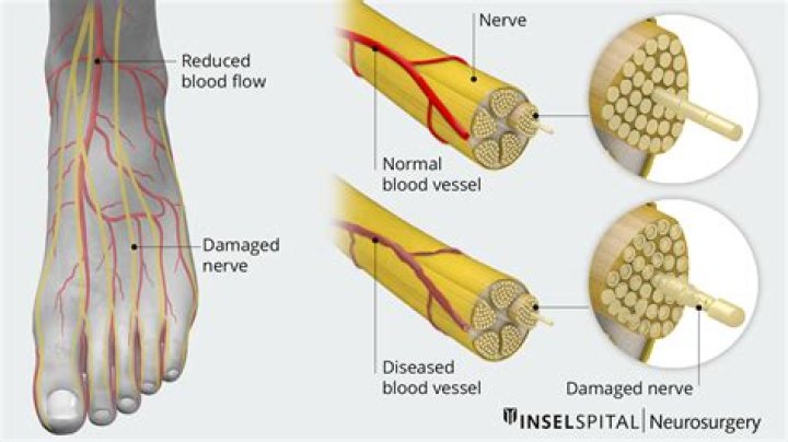 How is nerve damage in foot diagnosed?