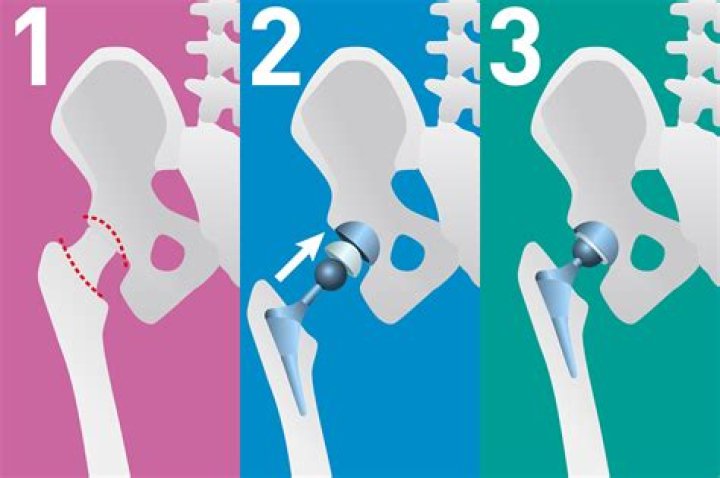 How long are you bedridden after hip replacement?