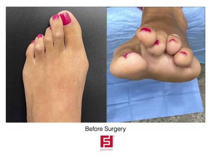 How long are you on crutches after bunion surgery?