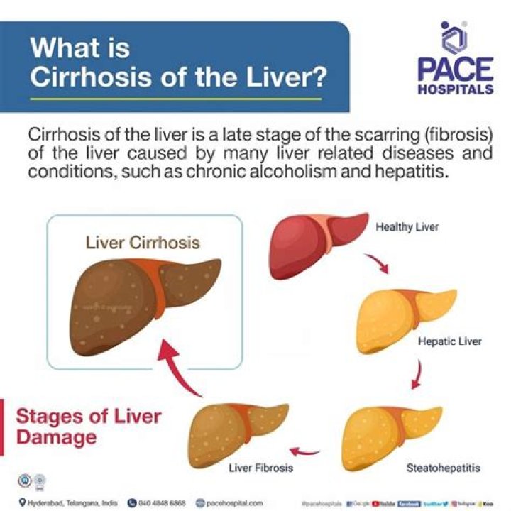 How long can you live with cirrhosis of the liver?