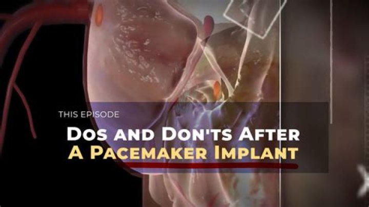 How long can you not drive after a pacemaker?