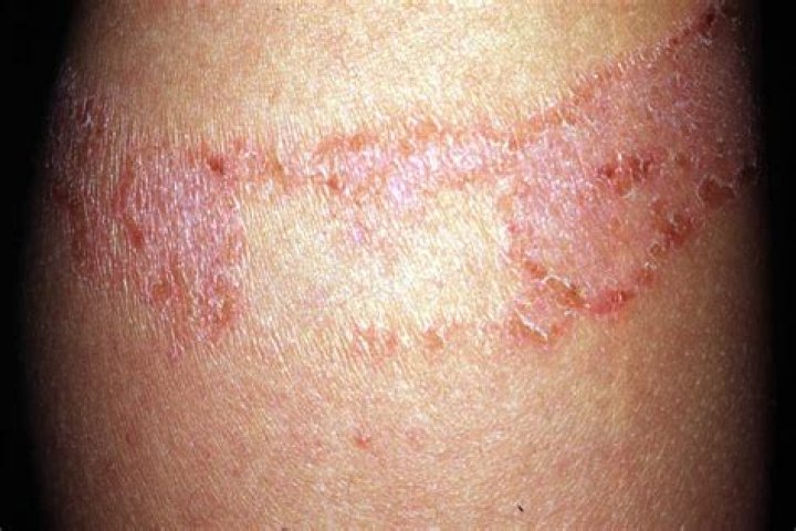 How long do allergic rashes last?