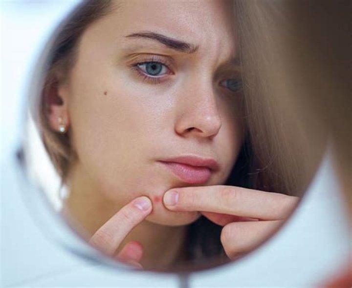 How long do forehead pimples last?