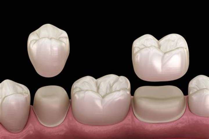 How long do Turkey dental crowns last?