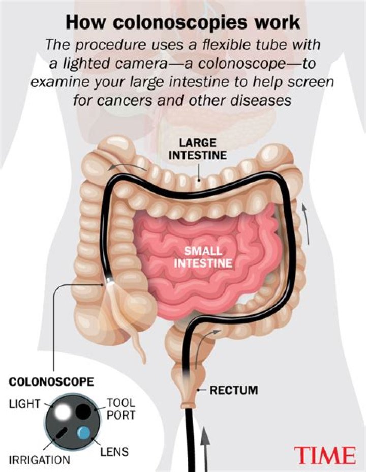 How long does a colonoscopy take with sedation?