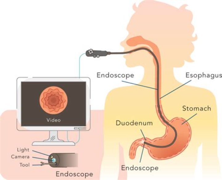 How long does an endoscopy take without sedation?