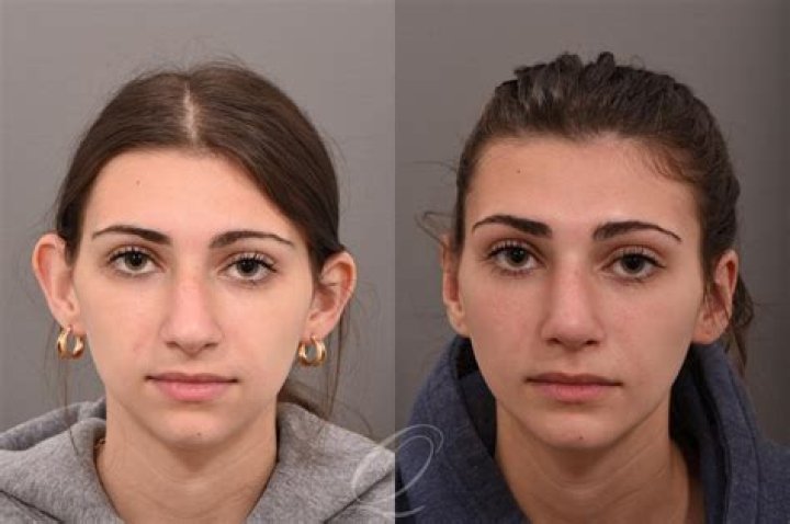 How long does cosmetic ear surgery take?