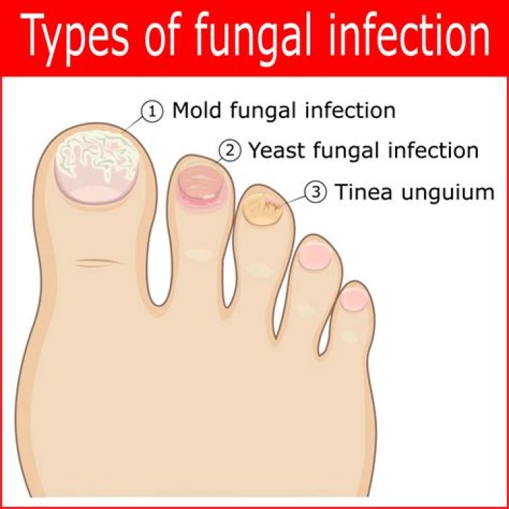 How long does foot fungus last?