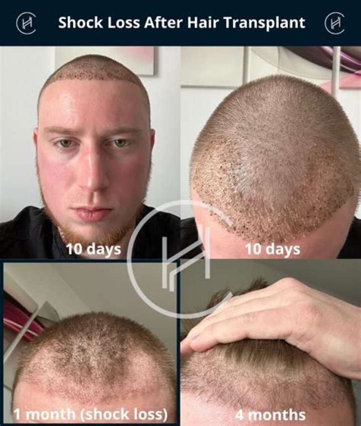 How long does hair loss from Covid last?