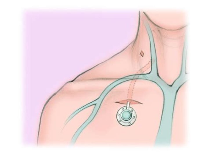 How long does it take for a chemo port to heal?
