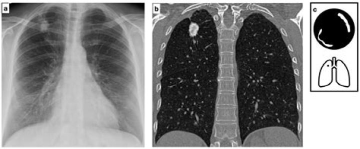 How long does it take for a granuloma to calcify?