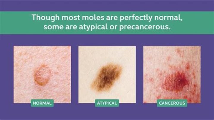 How long does it take for a mole to become cancerous?
