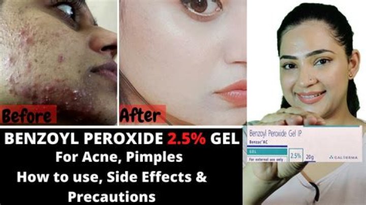 How long does it take for benzoyl peroxide to take effect?