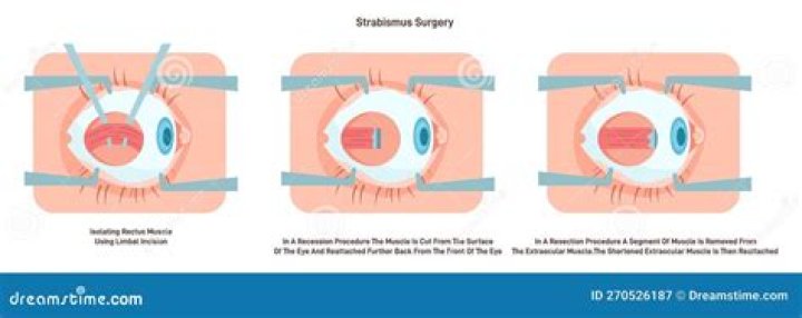 How long does it take for eyes to align after strabismus surgery?
