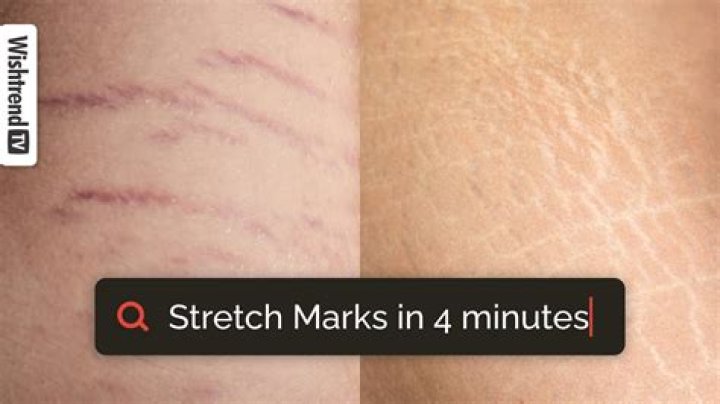 How long does it take for stretch marks to turn white?