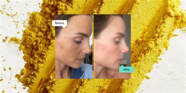 How long does it take for tretinoin to build collagen?