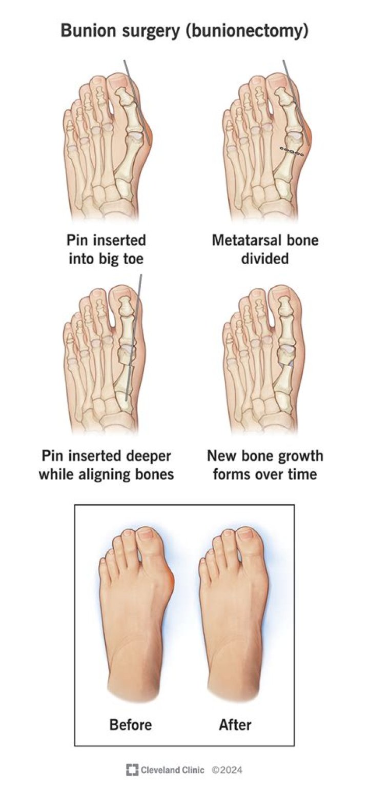 How long does it take to walk again after bunion surgery?